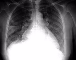 Patología pulmonar