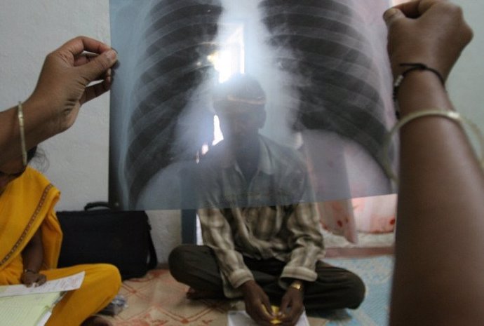 Hombre con tuberculosis