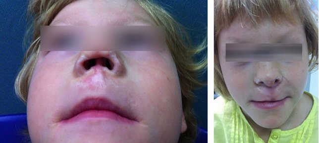 El antes y el después de la operación de nariz