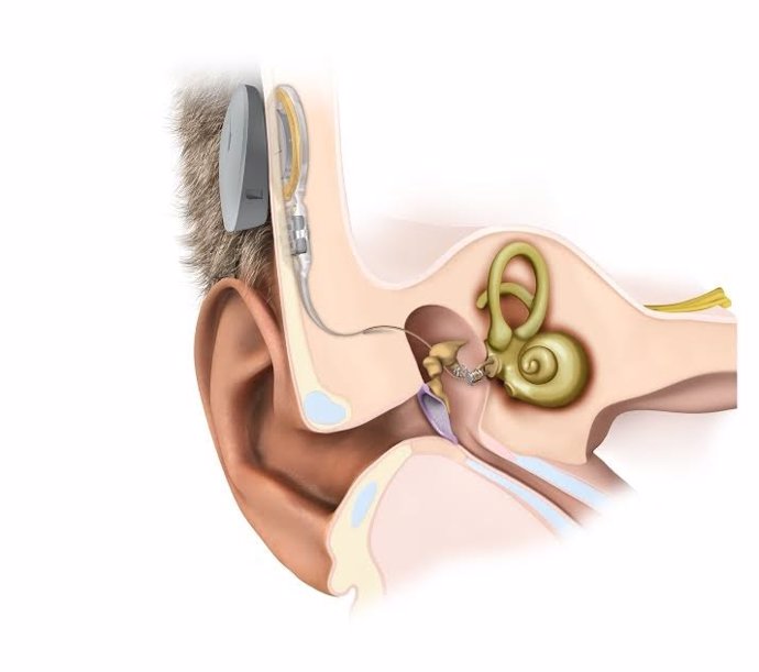 Ilustración del nuevo implante avanzado de oído medio.