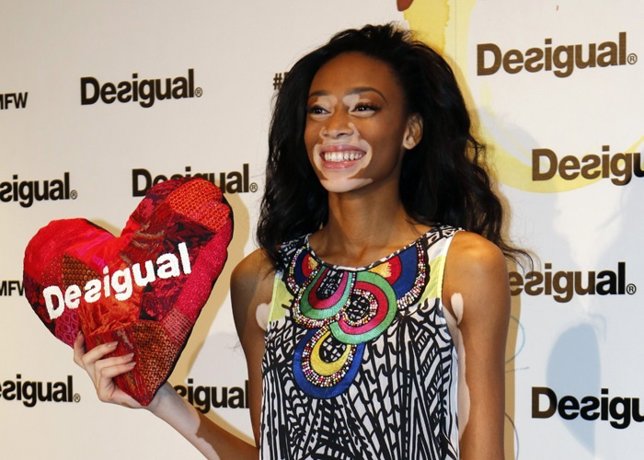 Chantelle Winnie, la primera modelo con vitíligo