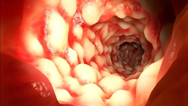 Colonoscopia cáncer de colon