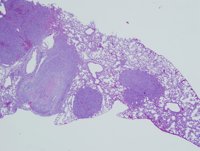 Detectar el cáncer de pulmón, ¿con una prueba de sudor?