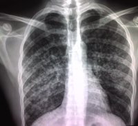 España reduce un 19% los casos de tuberculosis en dos años
