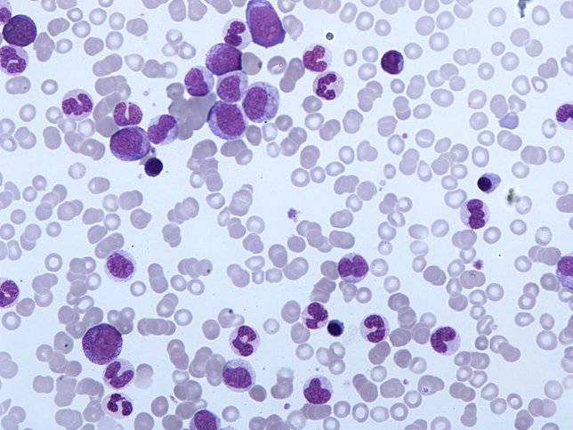 Leucemia