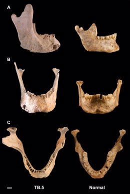 Huesos de mandíbula del "gigante" y un individuo con estatura normal medieval