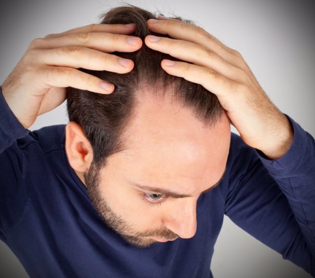 Alopecia, hombre, perder pelo