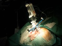 Cirugía de Parkinson, una alternativa para pacientes farmacoresistentes