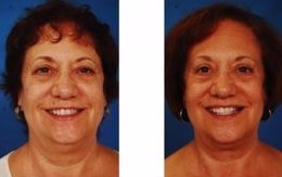 Antes y después de la cirugía estética