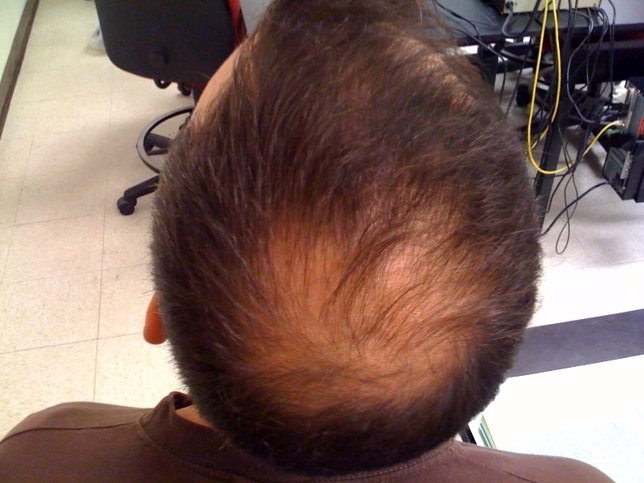Alopecia, cabello, pelo