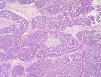 La supervivencia en cáncer de ovario se ha triplicado en 20 años