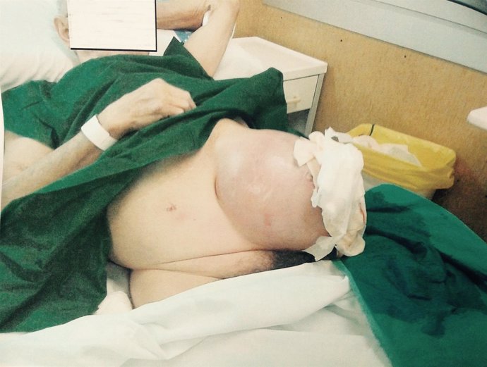 Paciente de Bellvitge con una hernia abdominal