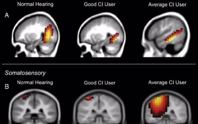 Reorganización cerebral tras la pérdida de audición