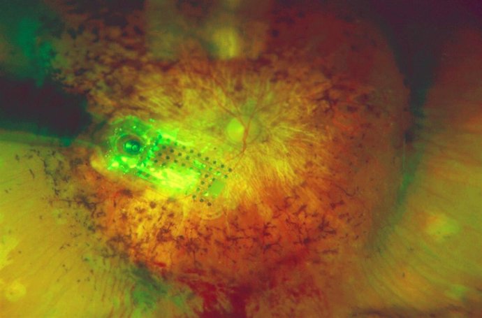 Un momento de la intervención para el implante del ojo biónico