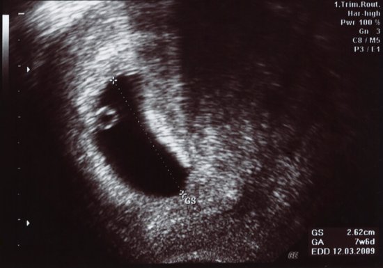 Desarrollo del embrión en la semana 5 de embarazo