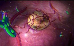 Avastin en cáncer de ovario