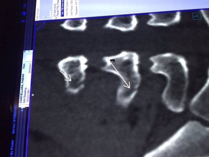 Radiografía de Cancellara tras su caída en el Tour