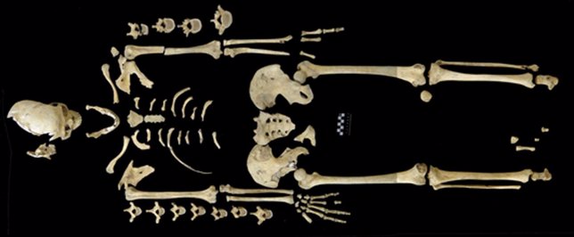 Esqueleto de mujer con leucemia hace 7.000 años