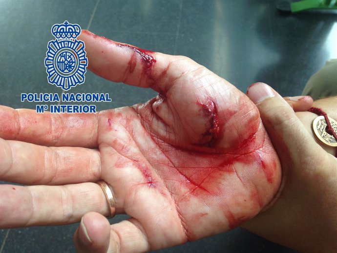 Imagen de la mano del agente herido por la mordedura del perro