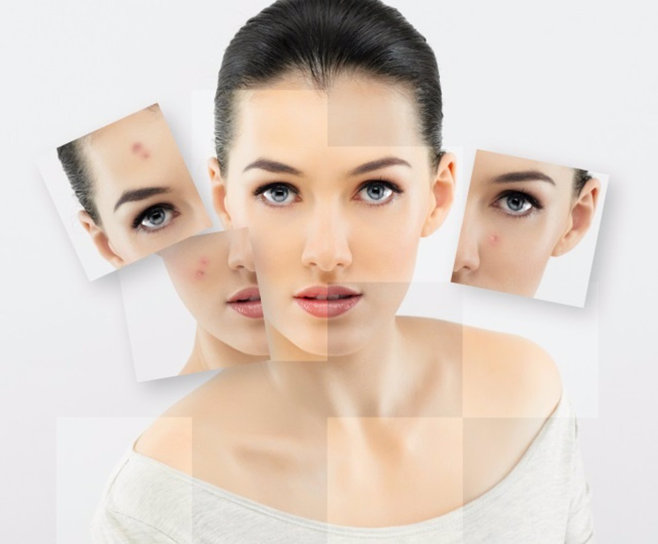 Las causas del acné adulto


