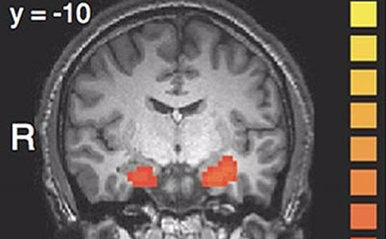 El 27% de los infartos cerebrales se deben a un ictus hemorrágico