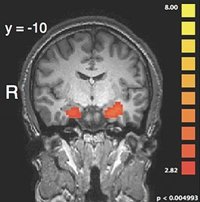 El 27% de los infartos cerebrales se deben a un ictus hemorrágico