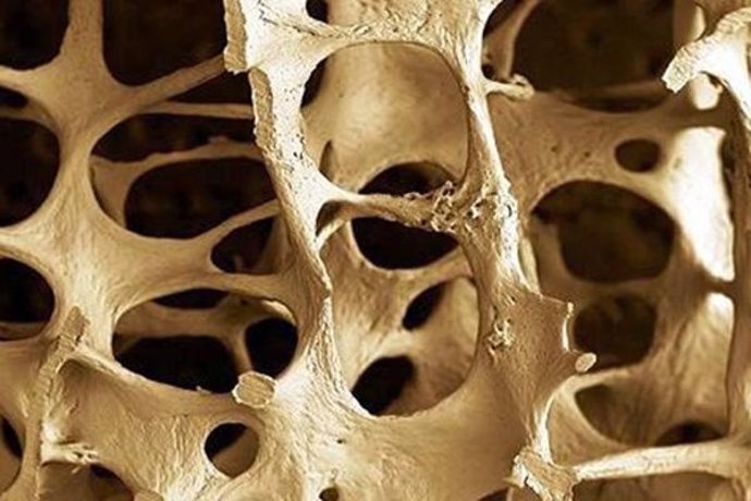 La osteoporosis afecta principalmente a mujeres mayores de 50 años
