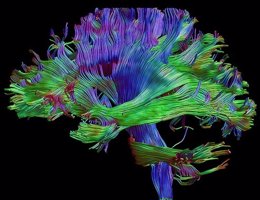 Imagen de cerebro generada a partir de resonancia magnética
