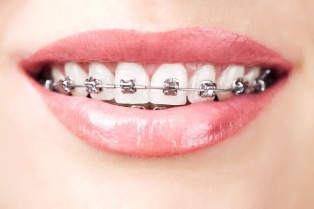 Brackets, dientes, ortodoncia