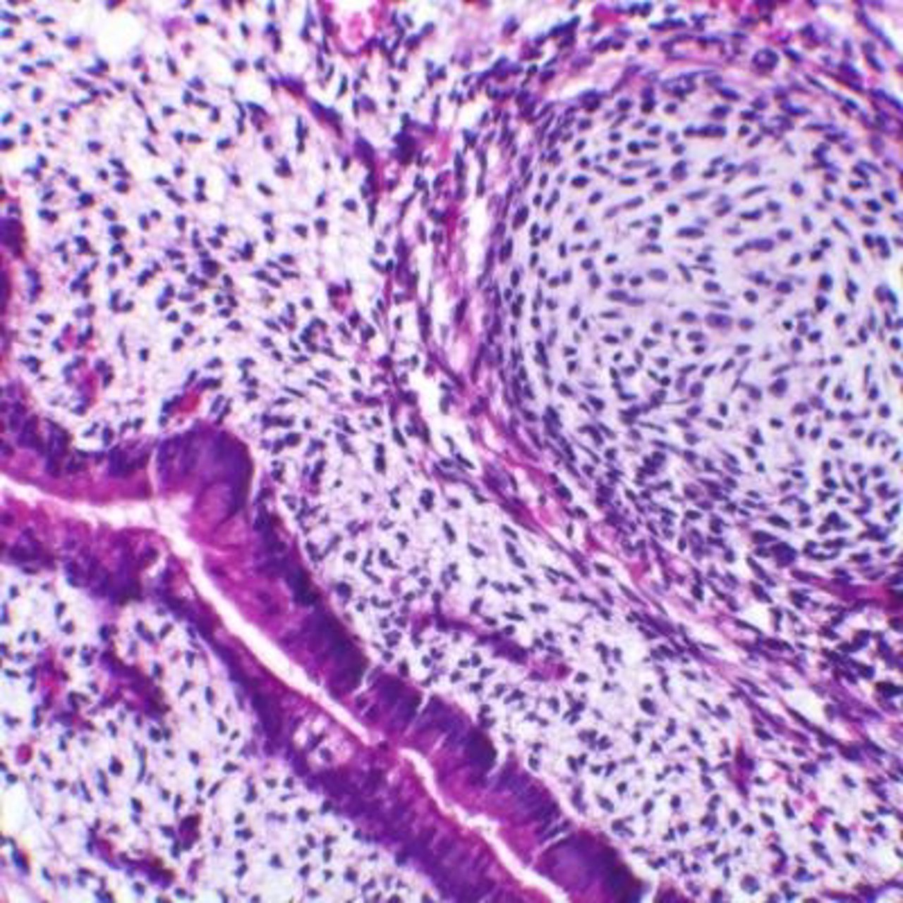 Identifican una molécula que parece alimentar la enfermedad genética mortal