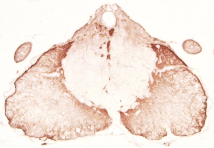 Médula espinal lesionada 