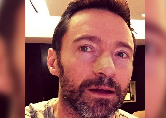 Hugh Jackman, quinta vez intervenido por su cáncer de piel