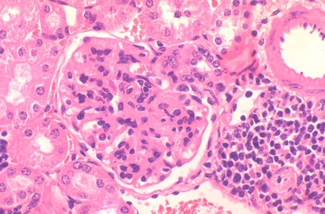 Lupus eritematoso