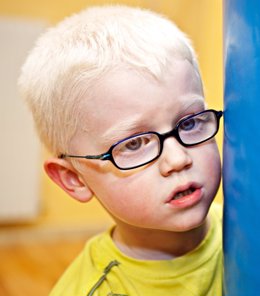 Niño albino. Niño con ganas que sufre albinismo