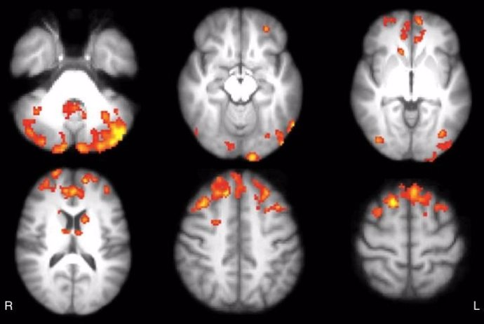 Videojuegos mejoram conexiones cerebrales en pacientes con esclerosis múltiple