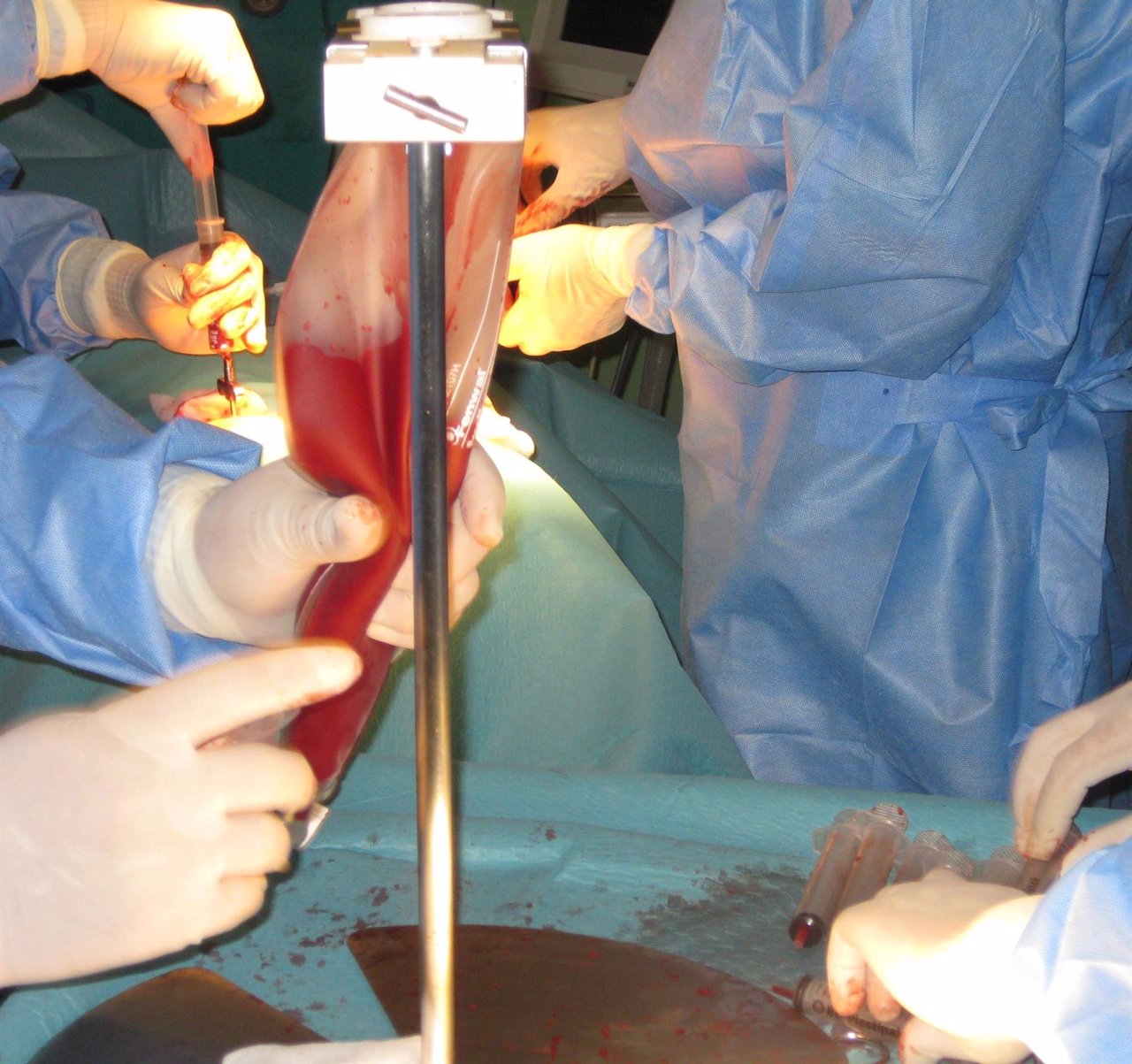 Técnica de extracción de médula ósea en quirófano