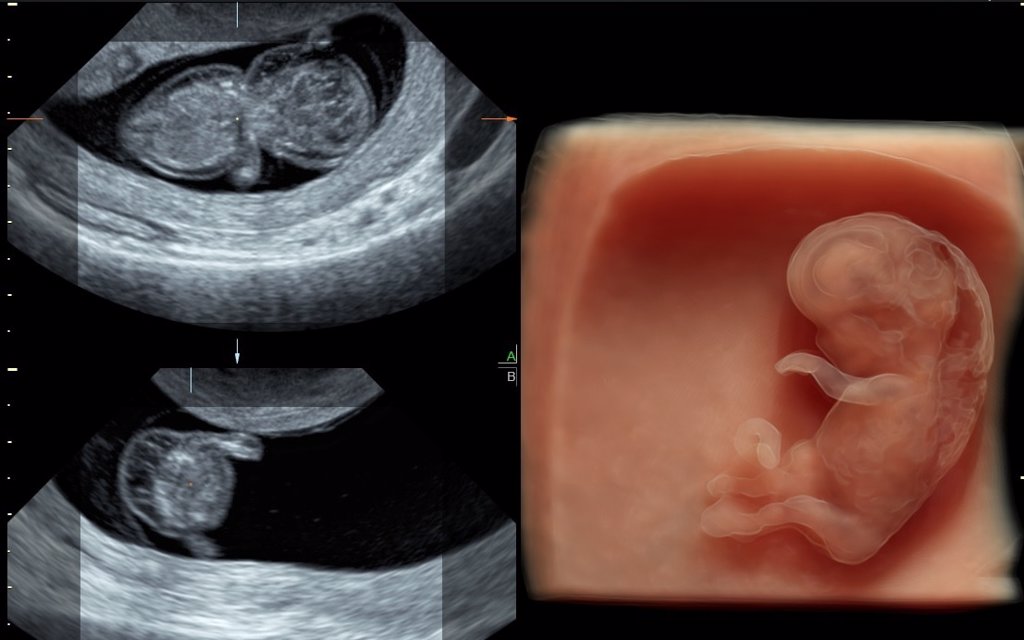 Un Ecografo 4d Detecta Hasta El 90 De Las Malformaciones Del Feto