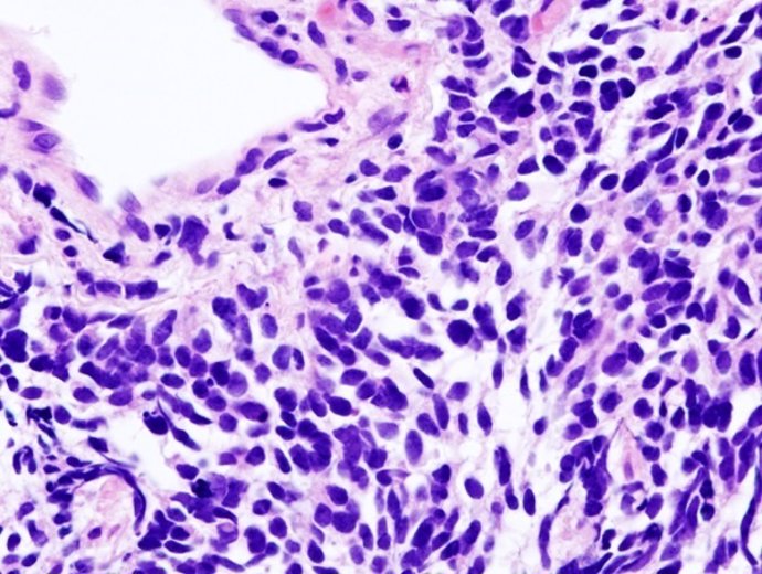 Carcinoma de pulmón de células pequeñas