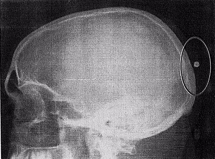 Radiografía del vigilante que recibió un perdigonazo en la cabeza