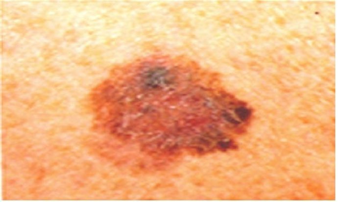 Melanoma