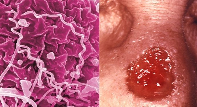 Aumentan los casos de sífilis