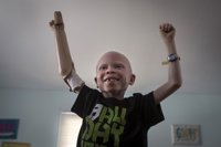 Marginación y supersticiones. El estigma de nacer con albinismo en África