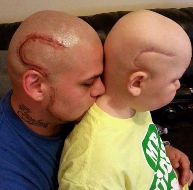 Padre se tatúa la cicatriz de su hijo con cáncer