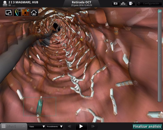 El nuevo stent instalado en la arteria coronaria