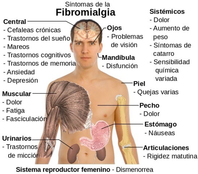 Síntomas de la fibromialgia