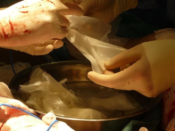 Primer transplante de piel humana fabricada con células de una paciente.