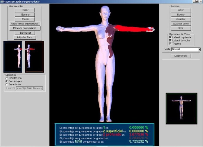 Nueva Aplicación Que Calcula La Superficie Quemada Del Paciente Hospital Virgen 