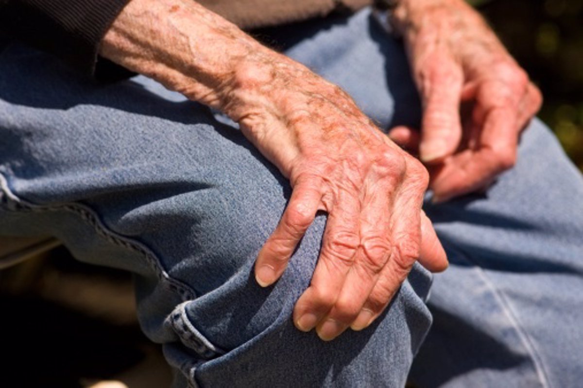 La artrosis sintomática de manos incrementa el riesgo cardiovascular
