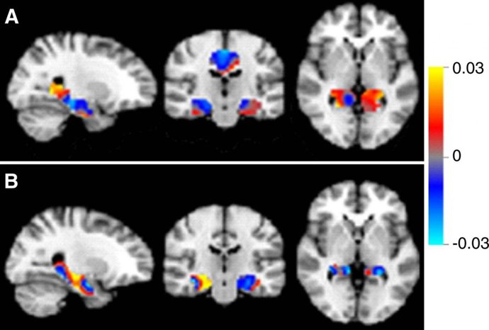 La inteligencia artificial puede ayudar a diagnosticar el Alzheimer