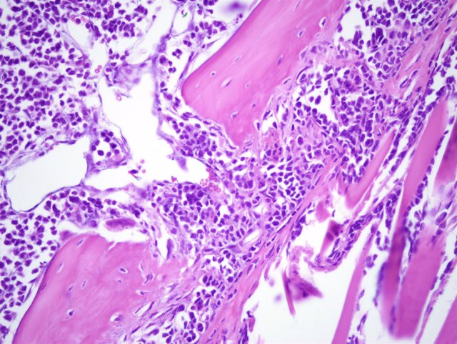 Lesión Litica del modelo de Mieloma Múltiple/ CSIC